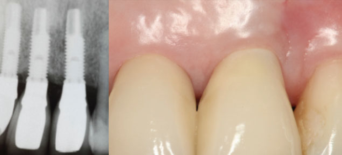 DENTAL IMPLANTS - Mediana Dental